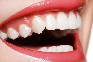 sbiancamento dentale