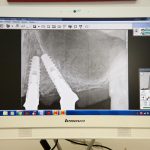 radiografia impianti